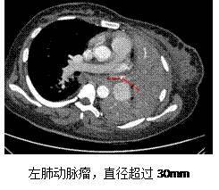 了解肺气肿，疾病性质、严重性及治疗前景