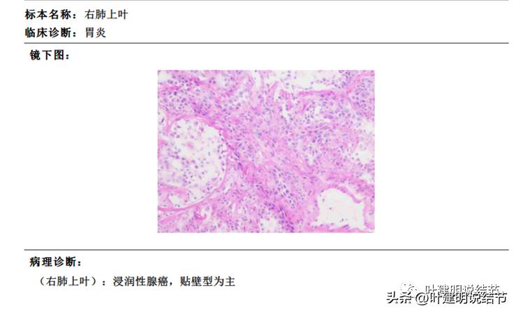 磨玻璃结节与肺癌的关系，事实与误解