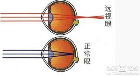 近视治疗方法与选择