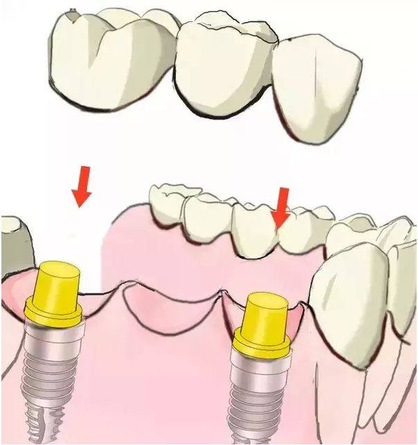 种植牙怎么做