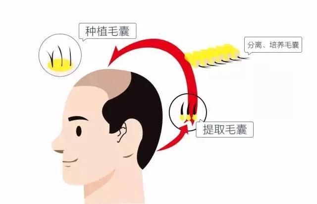 头发种植哪家好——选择专业与信誉并存的美发机构