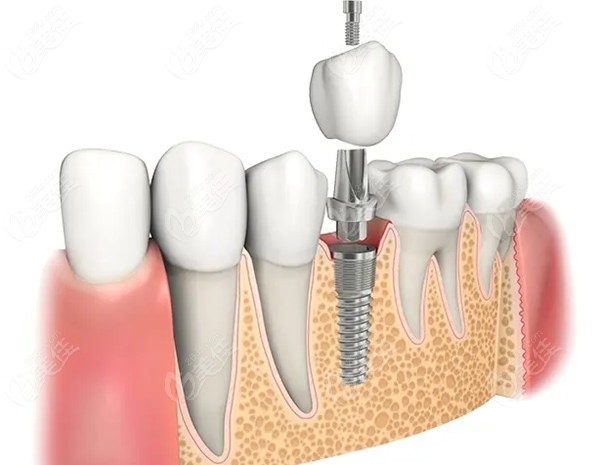 种植牙全口价格解析